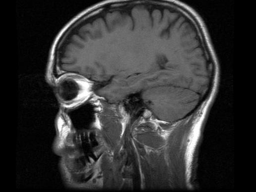 mri-head-scan-1439617